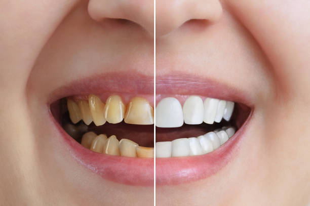 ما أبرز أسباب اصفرار الأسنان؟